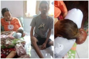 Derita Ewing yang Lumpuh Warga Cimarga, Istri Melahirkan Bayi Ada Benjolan di Kepala